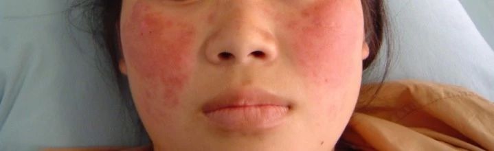 红白蓝疮是什么病?会有什么症状?应该怎么治疗?